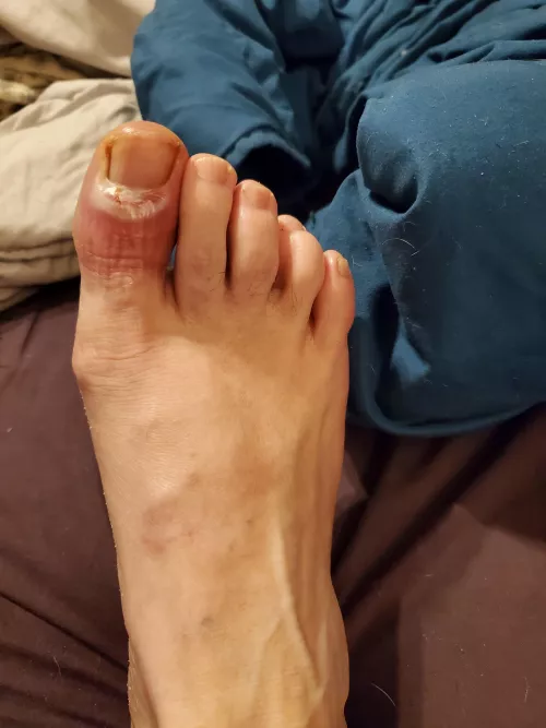 UPDATE: No worse, but no better either. Then I got a call from Urgent Care. The cultures came back, and this particular infection is resistant to my current antibiotics. Tonight I will pick up the new meds...hopefully I can post a more positive update in