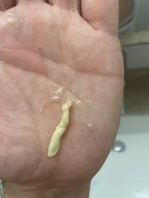 I had a painful blockage in my tear duct, and this came out (Dacryolith)