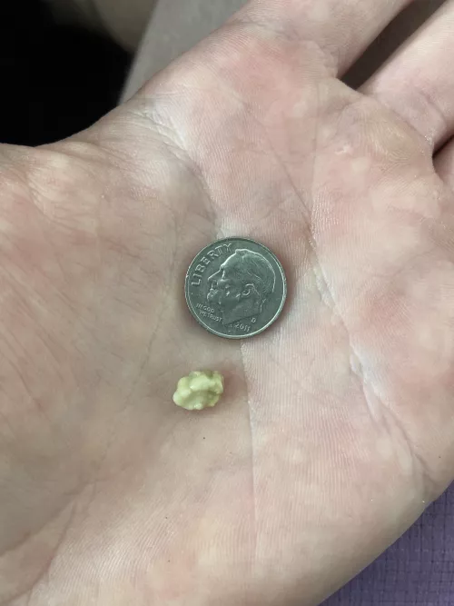 Was chewing gum and felt some pressure on my tonsil. Looked in the mirror and popped this monster out
