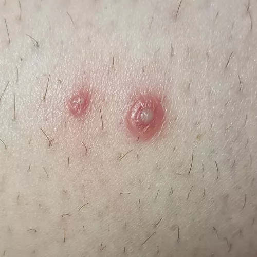 my forbidden heat rash pop