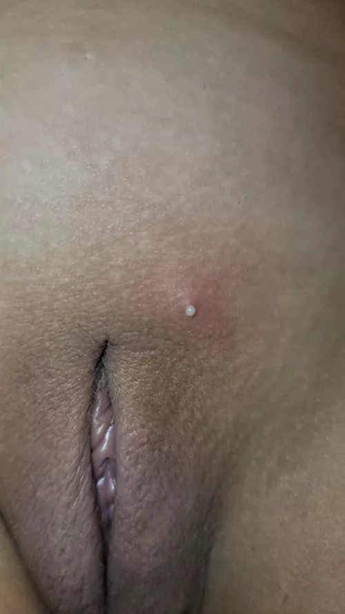NSFW- Hurt so bad, couldn't pop it myself. Popped on its own.