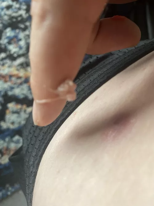 I have had a cyst on my leg for a year. I was scheduled next week to have surgery, but this happened today.