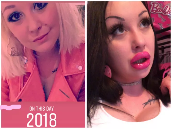 Thank f💗ck for fillers!