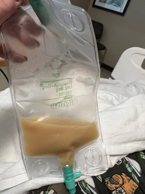 My abdominal abscess buddy for the next few days.