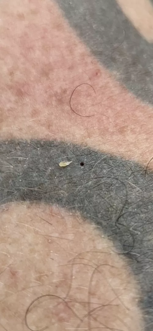 my partner gets these gnarly boys on his back, sooooo satisfying