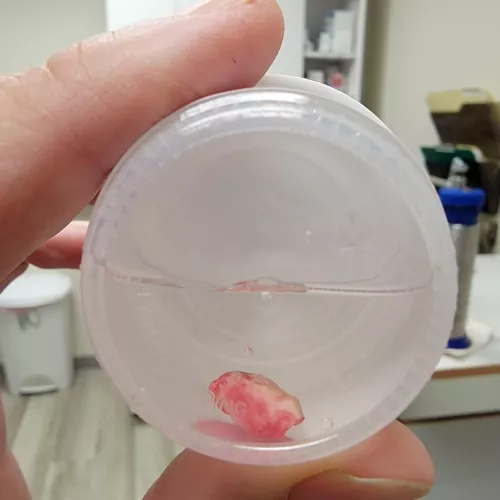 I gave birth to another neck cyst