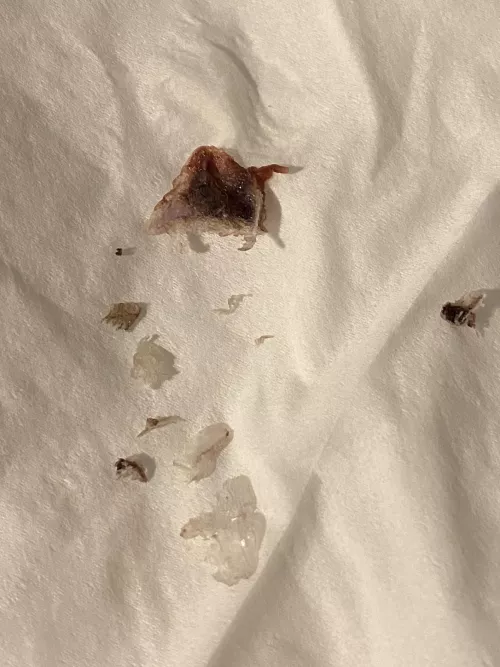 A scab I pulled out of my belly button after hysterectomy