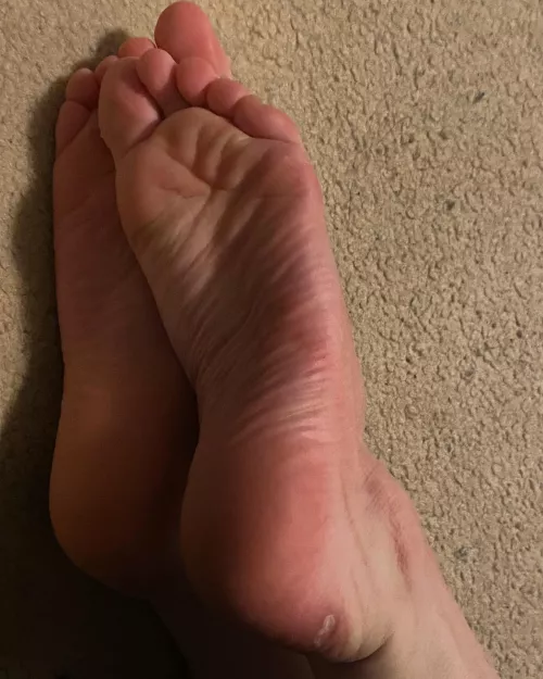 i got a blister, does someone want to kiss it better?