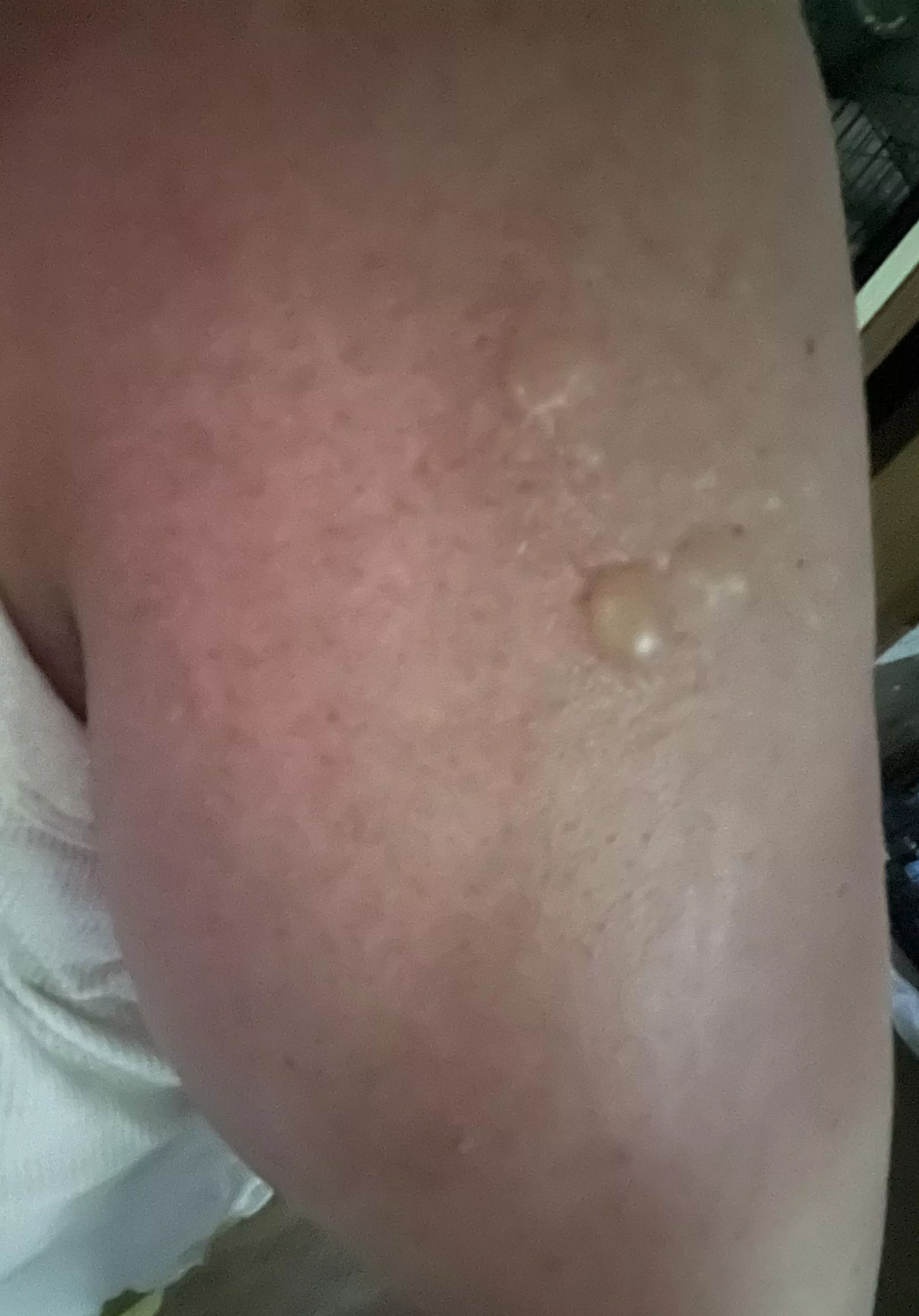 Wear sunscreen if you’re a pale homebody. I know I shouldn’t pop and frankly in too much pain to reach it to pop it! Wear sunscreen if you’re a pale homebody. I know I shouldn’t pop and frankly in too much pain to reach it to pop it!