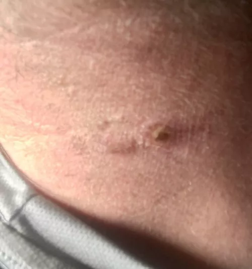 Can anyone tell me what this is? Thought it was an Ingrown hair but blew up overnight