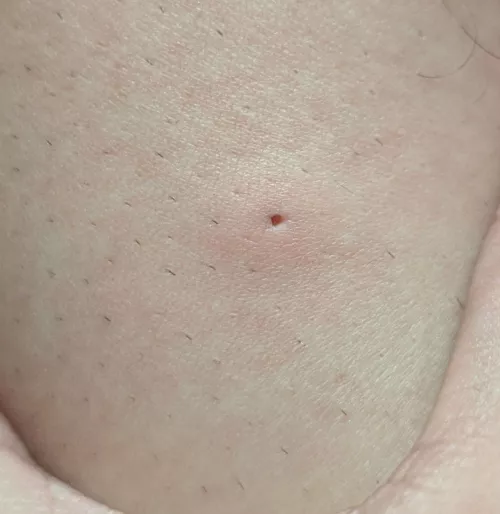 Is this hole from and ingrown hair? I have had it for a long time