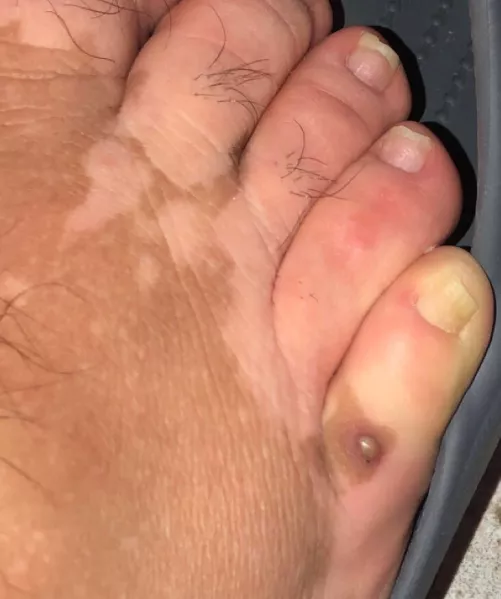 Scared. Is this Boil or MRSA or Staph?