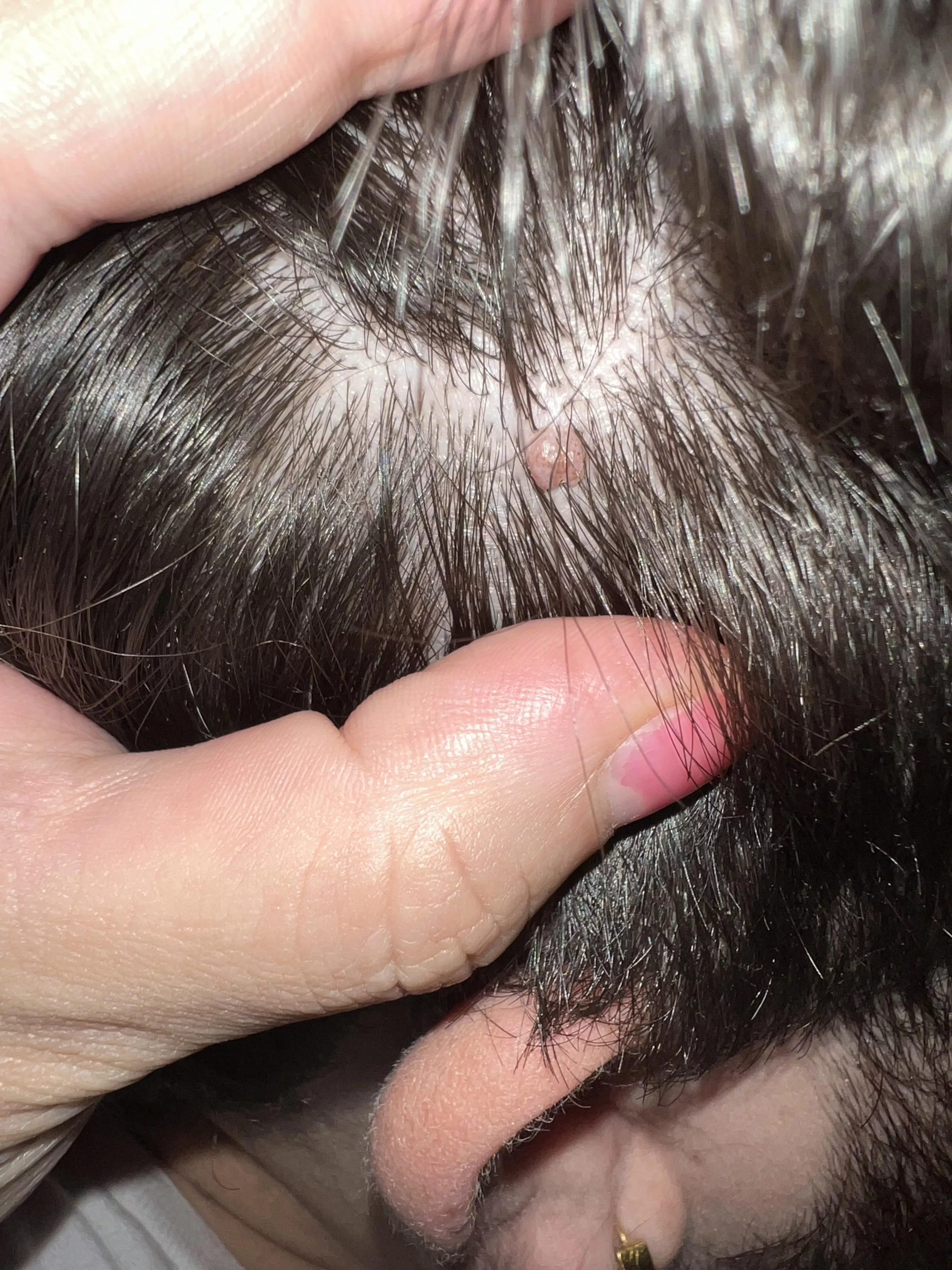 What is this bump? Been there for years and always gets irritated after a trip to the barbershop. Skin tag? C word? Gonna schedule a trip to the dermatologist soon but curious if anyone knows. What is this bump? Been there for years and always gets irritated after a trip to the barbershop. Skin tag? C word? Gonna schedule a trip to the dermatologist soon but curious if anyone knows.