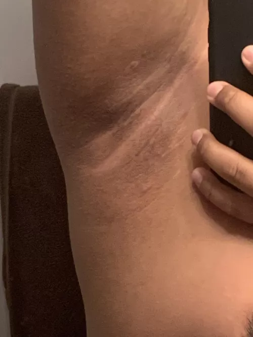 Reddit do you have any idea what this is under my armpit it’s kinda itchy but I’m not sure if it’s a hive or not