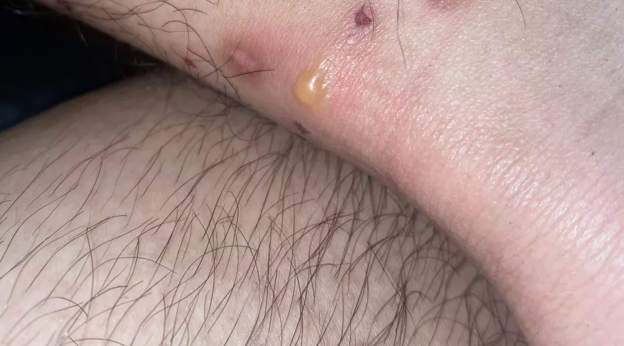 random boil on boyfriend’s ankle among other bug bites from outdoors, could this be a spider bite? he really wants to pop it but i’m wary of it getting infected. we’re located in southern CA and aren’t sure what spider or bug it would’ve been.