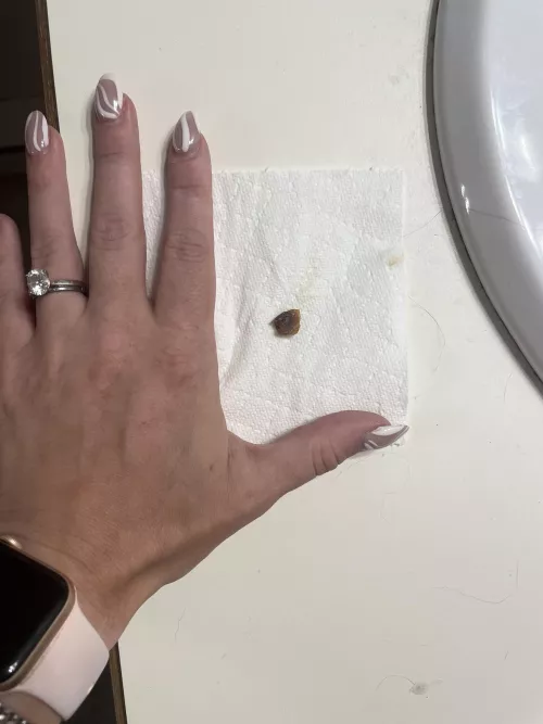 This impacted earwax we pulled from my husbands ear is so satisfying