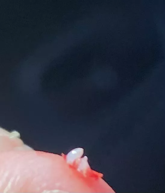 I get these plugs under my facial skin that cause pimples that won’t heal until i pull them out. What are they?! Literally the pimples last for weeks. I get these plugs under my facial skin that cause pimples that won’t heal until i pull them out. What are they?! Literally the pimples last for weeks.