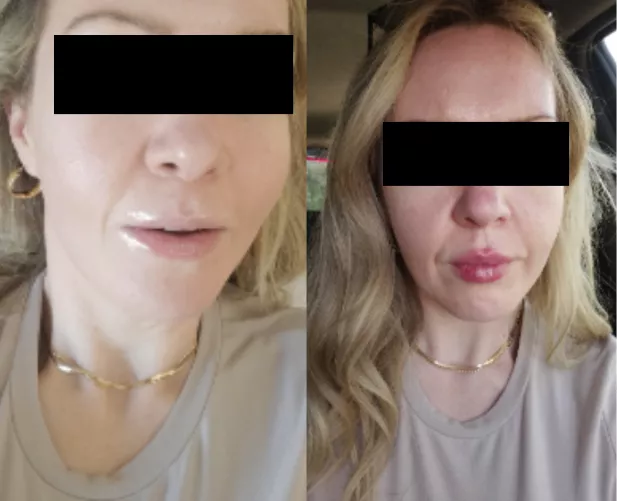 Ongoing bimbofication of my (37F) wife - previously 1650cc implants, now first size upgrade on lips (1 vial)