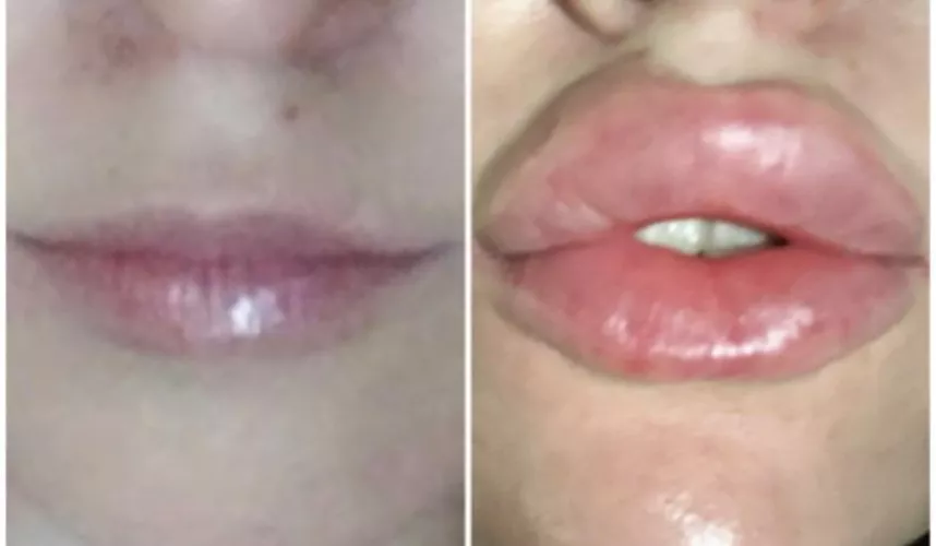 Before and after when I got my last lot of fillers done 💉 I miss this big juicy puffy look and feel! Want me to go bigger? Looking for sponsors 😘