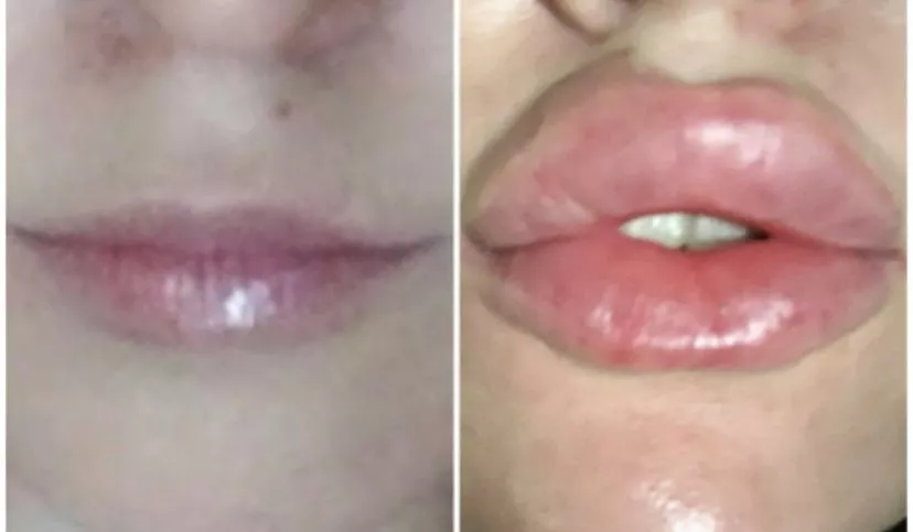 Before and after when I got my last lot of fillers done ๐ I miss this big juicy puffy look and feel! Want me to go bigger? Looking for sponsors ๐ Before and after when I got my last lot of fillers done ๐ I miss this big juicy puffy look and feel! Want me to go bigger? Looking for sponsors ๐