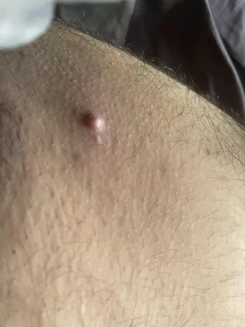 I don’t know what this is, cannot pop it and it hurts on my inner thigh