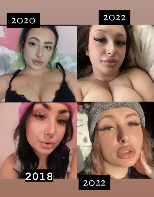 Fell in love with fillers and never going back🥰