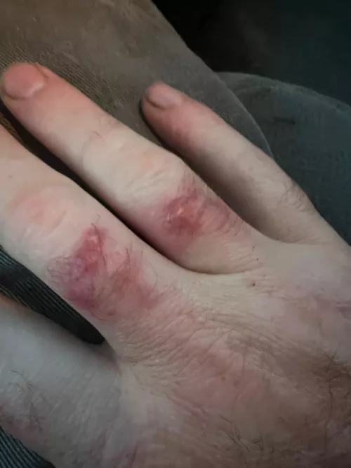 Has anyone ever gotten red bumps on your fingers after fisting? I’ve attempted to fist my Fiancé twice now. After the 1st & 2nd time I got these red bumps on my fingers. They itch/feel irritated. Think maybe it’s pulling on my hair because it’