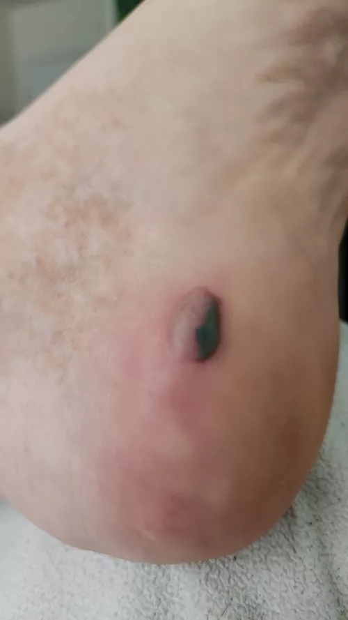 I've never had a foot blister this bad, how do I treat it? I have work in 3 days :(