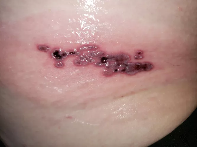 My worst cluster of shingles. Forbidden pops, excruciating pain.