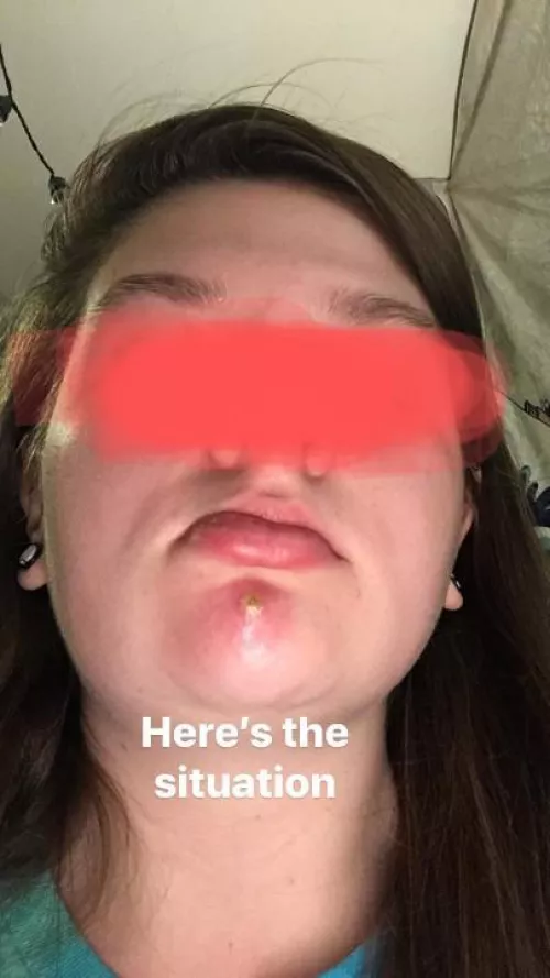 My sister's infected pimple from three years ago.