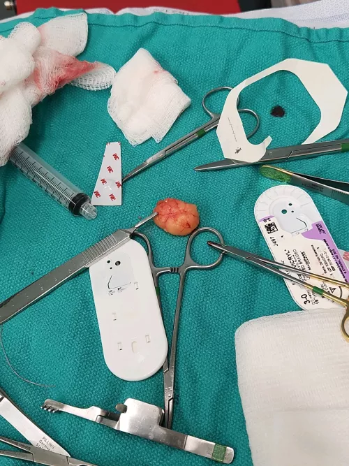 Just had this huge bastard pulled out of my arm. Immense relief.