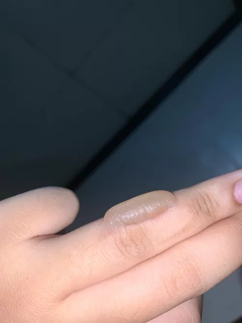 Treating this 4-day old burn blister as my little baby 😝