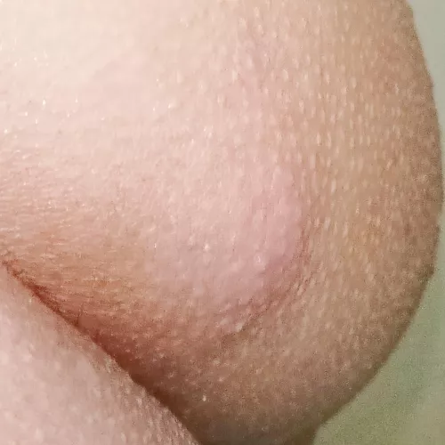 Huge bump near the top of my cheeks. Should I be worried? I've been wearing really tight underwears in the last 3 days and this pop up. Is it a cyst? Someone help me 😭