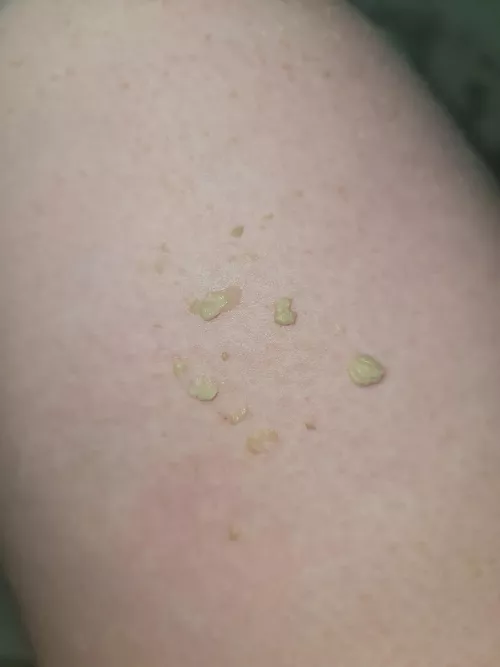 This all came out of my ear - still some left.