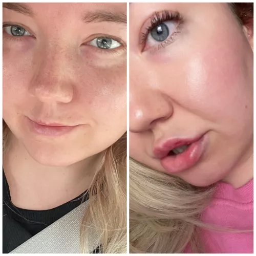 I swear I’ll only do one syringe! (I’m going for my 3rd tomorrow 😅)