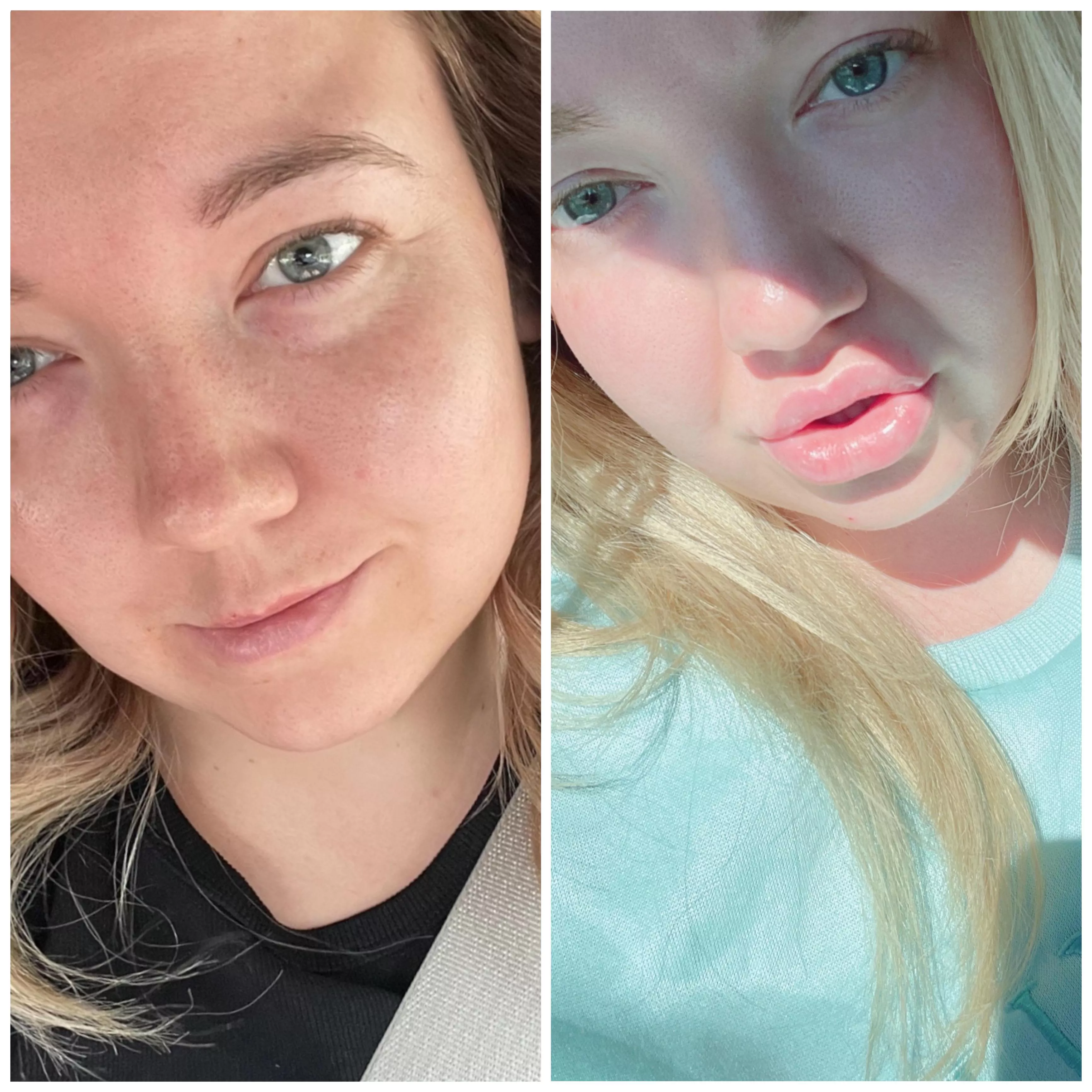 Got my 3rd syringe today 🙊 quite the before & after! 💕