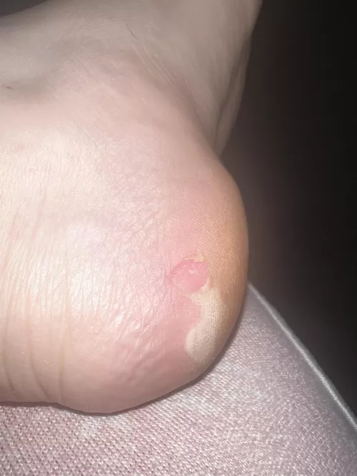 Blister - woops… advice? I cut this partially after I had this for a month. Thought it was just dead skin. NOPE. Lots of fluid. This wraps around my heel. Do I leave it alone and how long will it take to heal?! ITS SO DEEP.