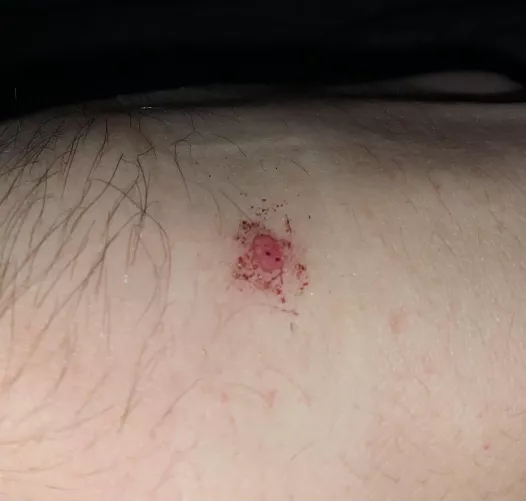 Chopped off my own skin tag