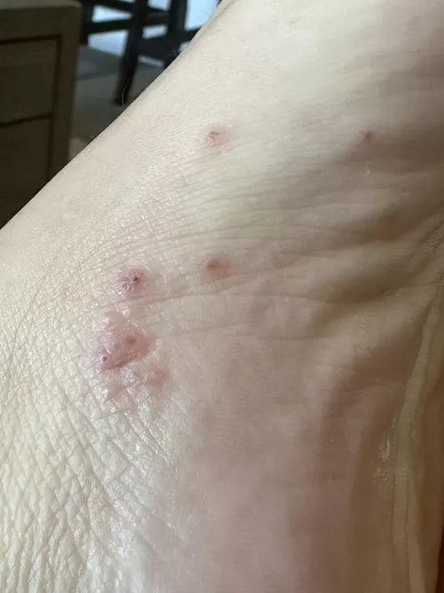 Couldn’t resist popping my foot. One was yellow inside, the others were clear.