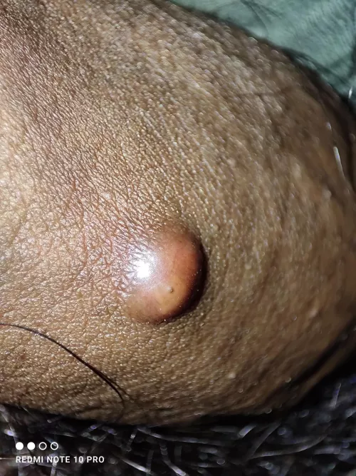 Guys I am 18 I need help with this. This was very small for 2 months, Its started growing a little 5 days ago and it became big day before yesterday . It's very painful