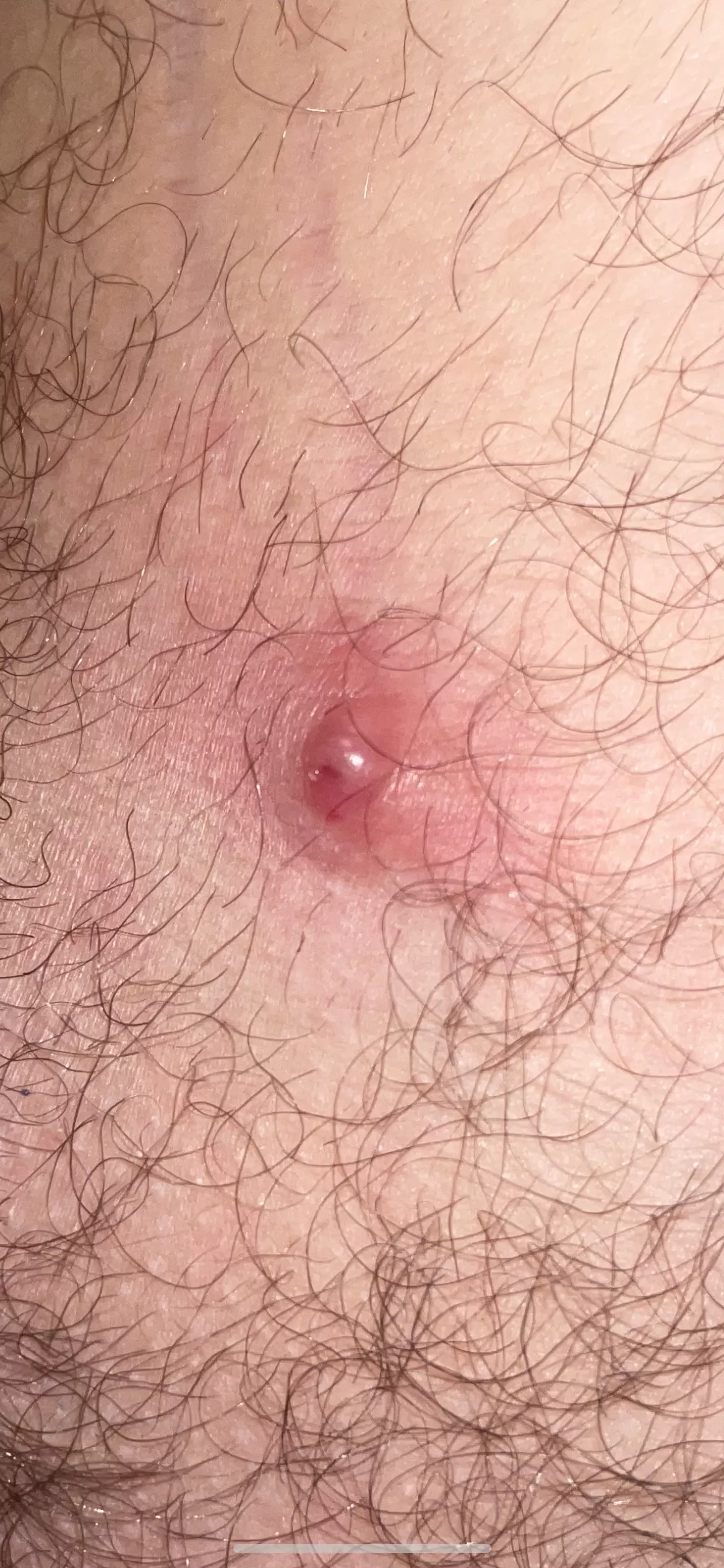This uncomfortable large bump appeared in the nether region. What is it. Tried to squeeze it but nothing came out (that mighta been a mistake) I sprayed with anti-bacterial spray and covered with band-aid for now. This uncomfortable large bump appeared in the nether region. What is it. Tried to squeeze it but nothing came out (that mighta been a mistake) I sprayed with anti-bacterial spray and covered with band-aid for now.