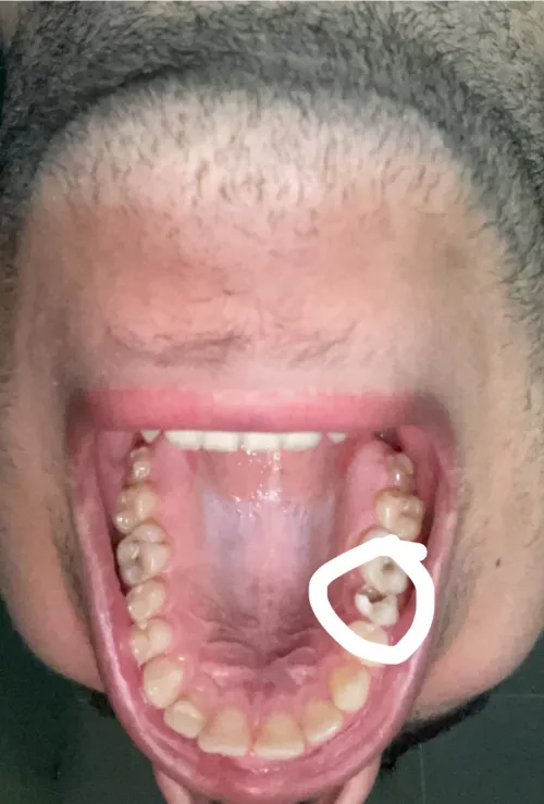 Tooth is chipped from the inside. Any idea what to do?
