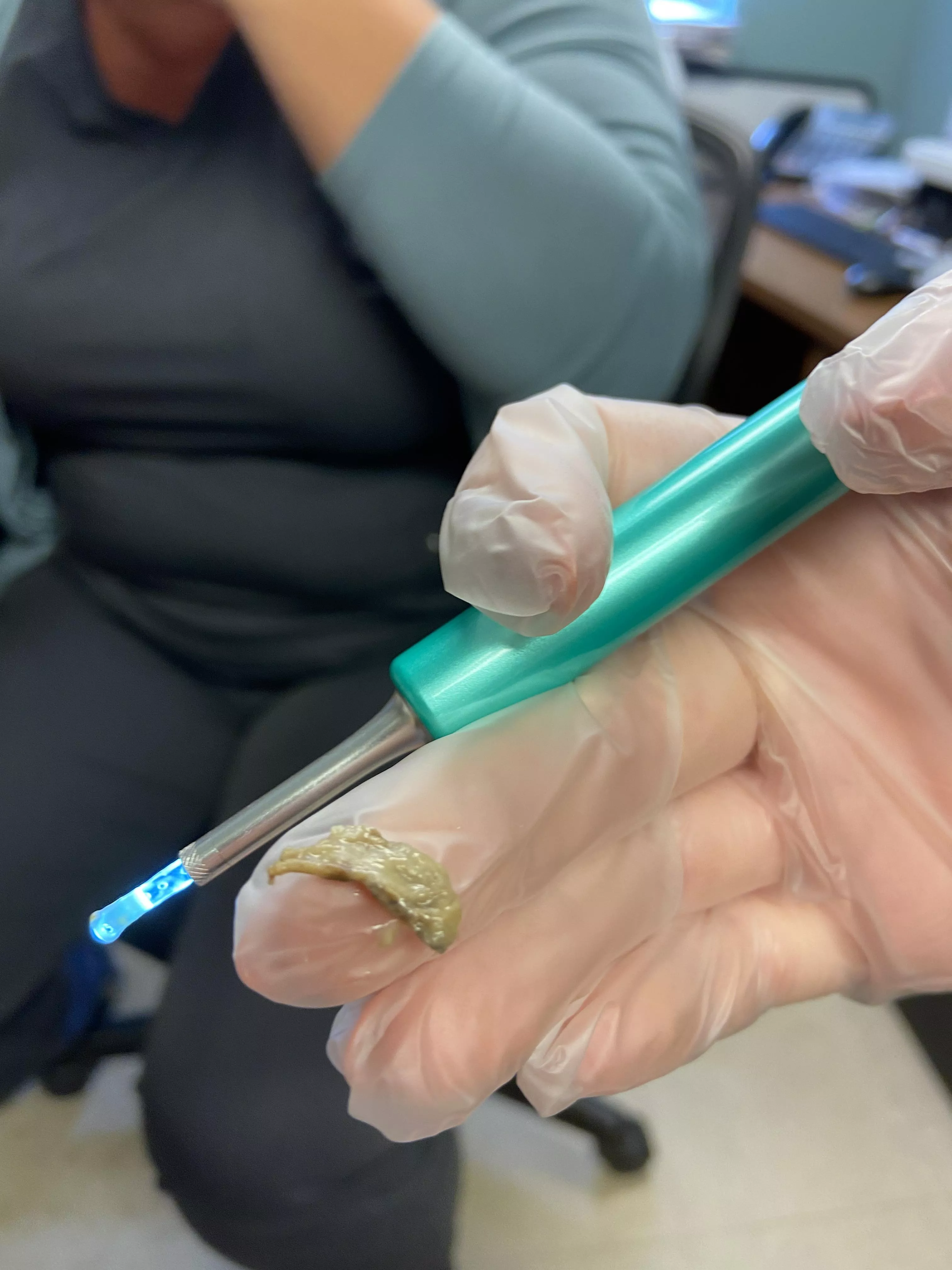 After 2.5 weeks of a blocked ear, using ear wax removal drops and a flushing, a nurse I work with was able to get this sucker out!🤢 (we forgot to hit record sadly) :( After 2.5 weeks of a blocked ear, using ear wax removal drops and a flushing, a nurse I work with was able to get this sucker out!🤢 (we forgot to hit record sadly) :(