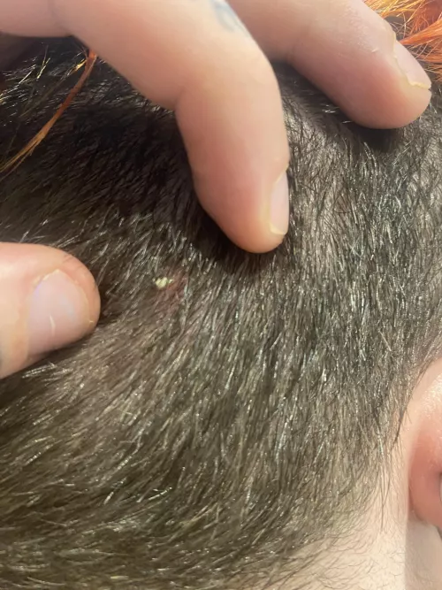 Husband squeezed an ingrown hair from my scalp