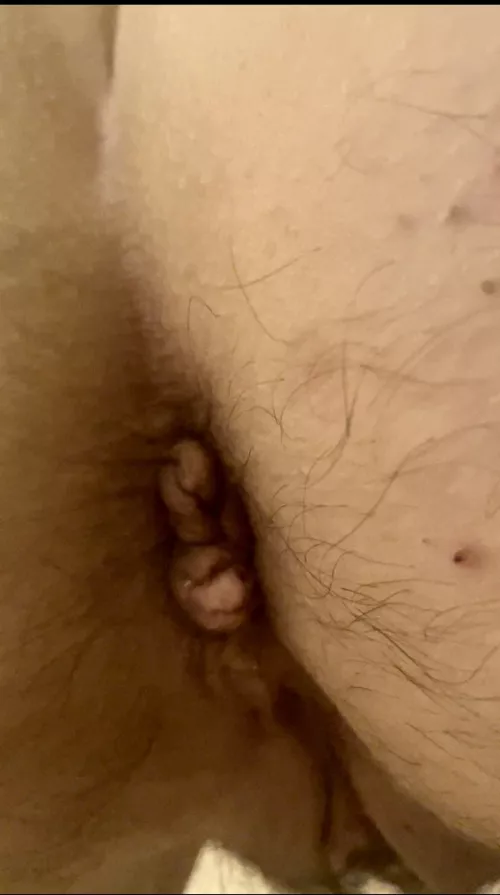 Close up of hairy ruined asshole