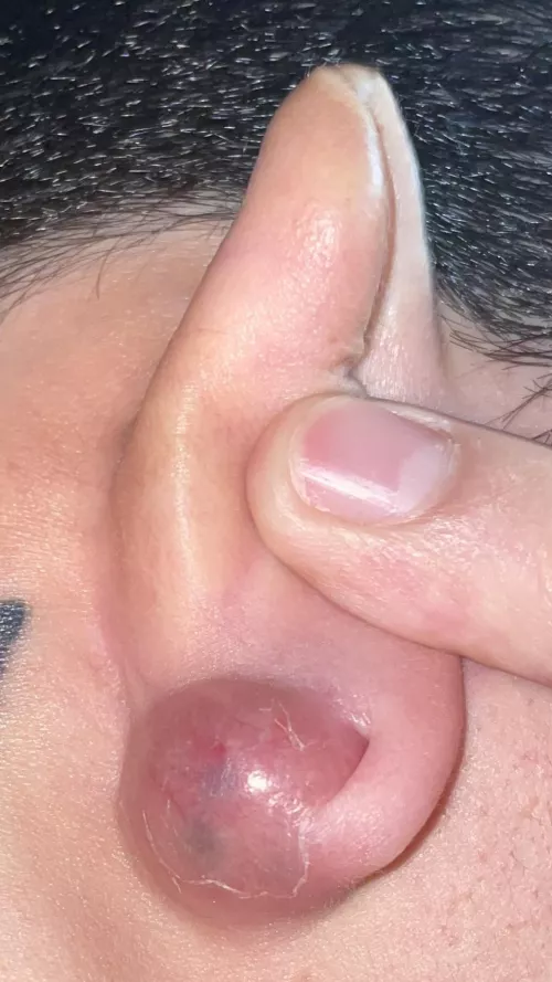 I get this on my right earlobe yearly. I think it may be time to get the sac removed or whatever. In the mean time, I'm gonna pop it! I'll post the aftermath soon hehehehe