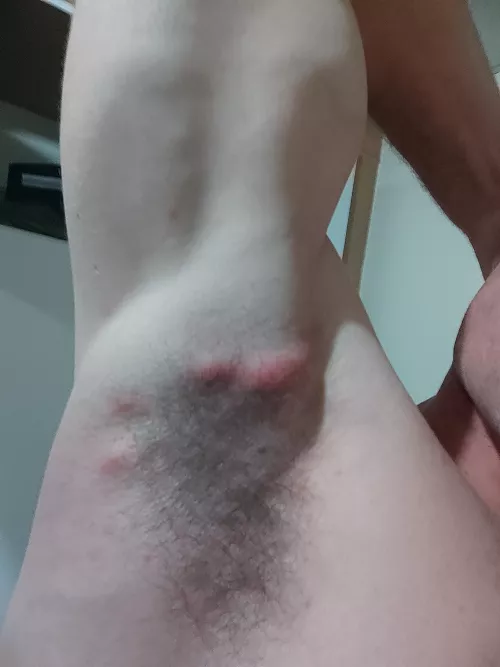 I need help identifying this lumps under my arm. they started off small but have gotten gradually bigger.