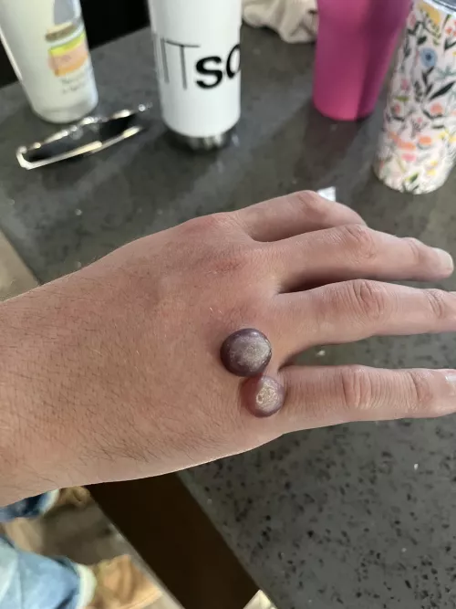 How many upvotes to pop or drain these gumdrop lookin suckers ??