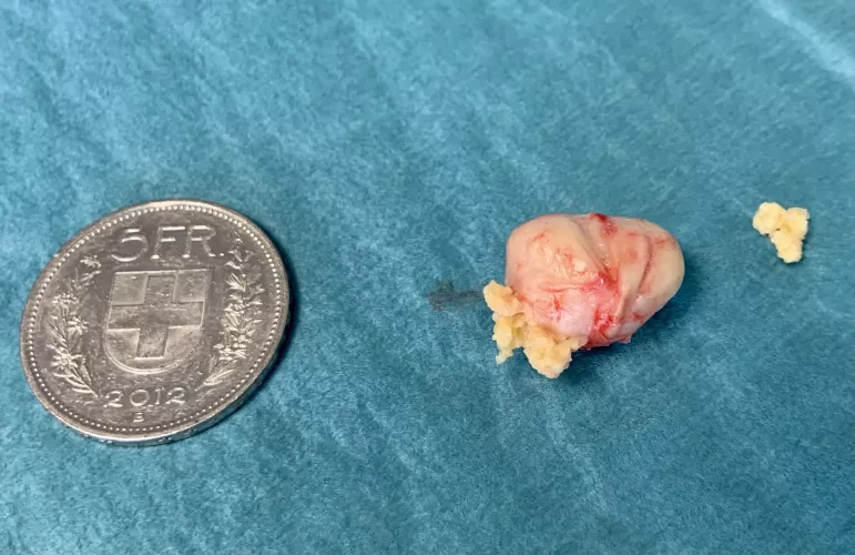 Cyst from my back, coin (31.45mm diameter) for scale
