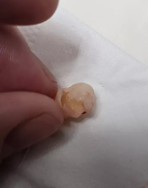 Had to have a ruptured Pilar cyst on my head drained last week. Today the sack came out (thank goodness).